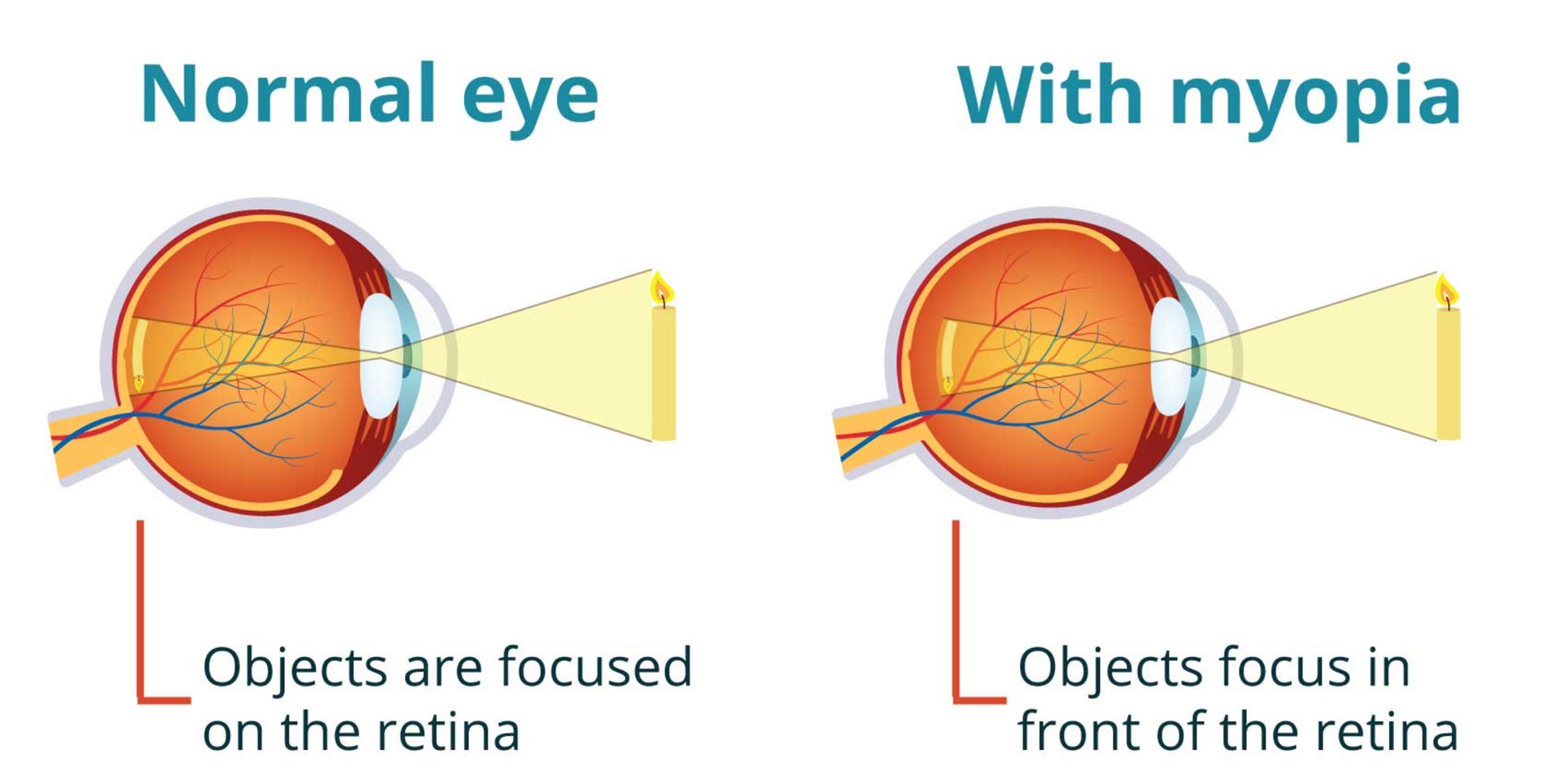 myopia image